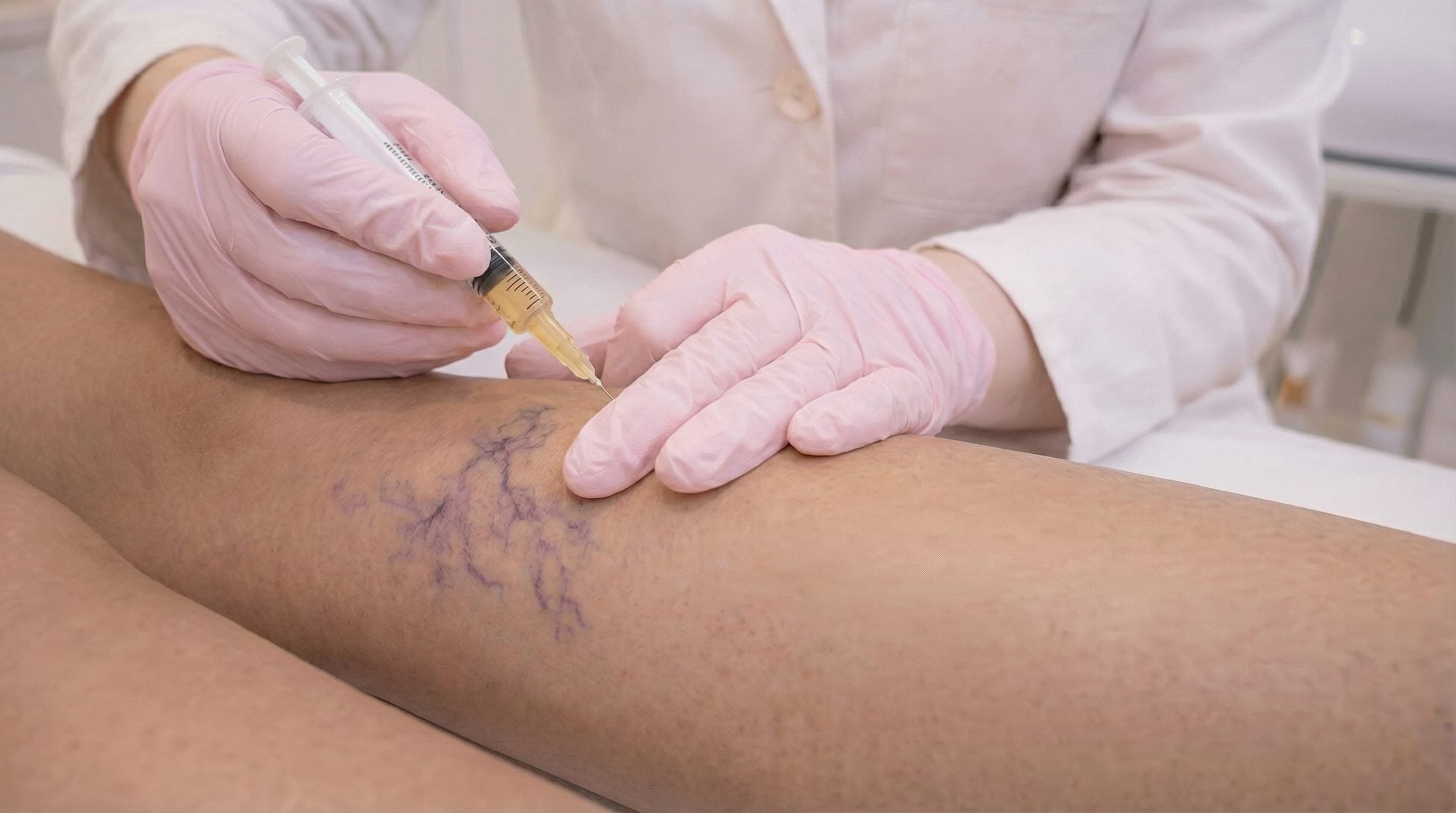 Secagem de Vasinhos - Dra Karine Fernanda Santo André