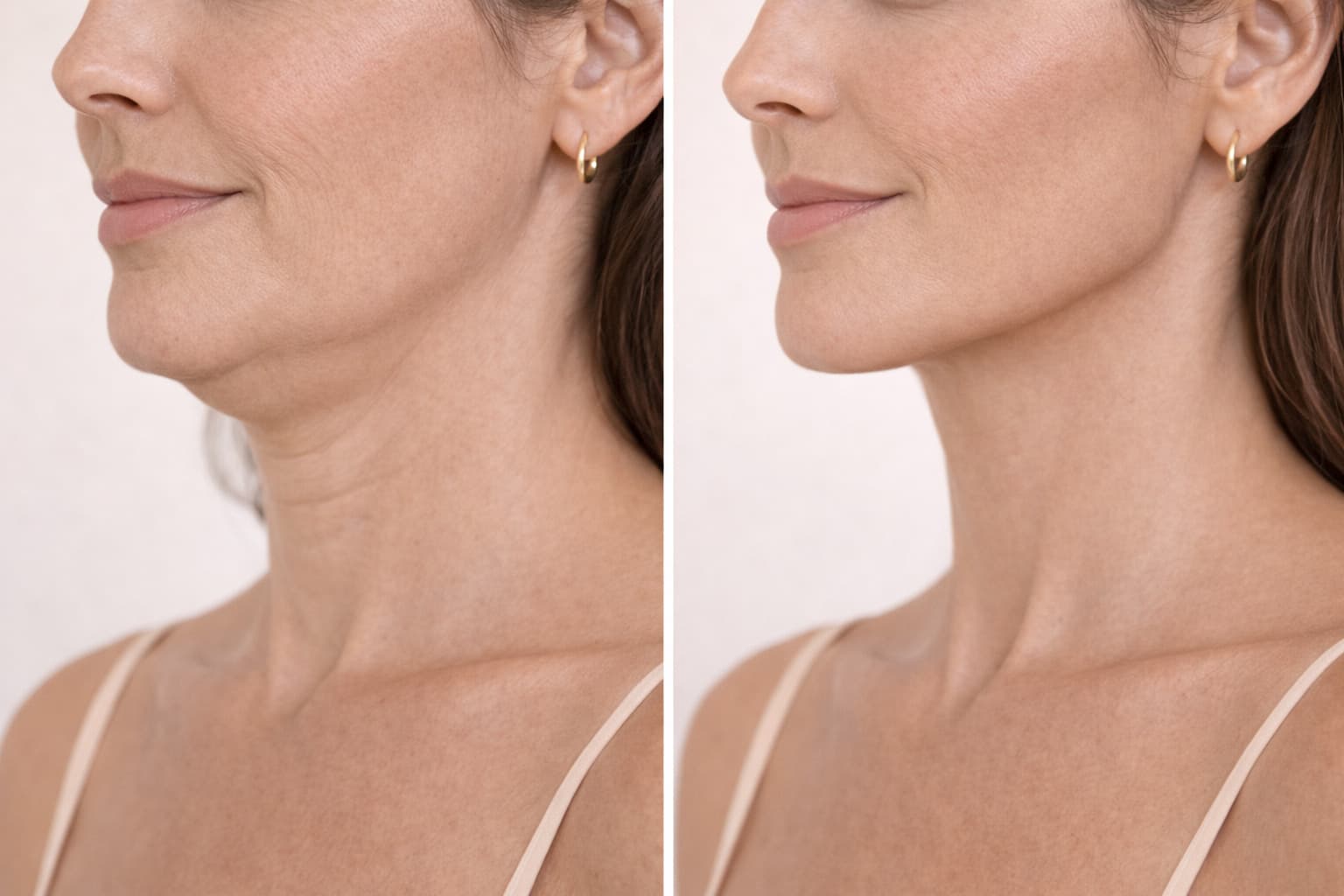 Tratamento de papada com enzimas lipolíticas injetáveis sem cirurgia