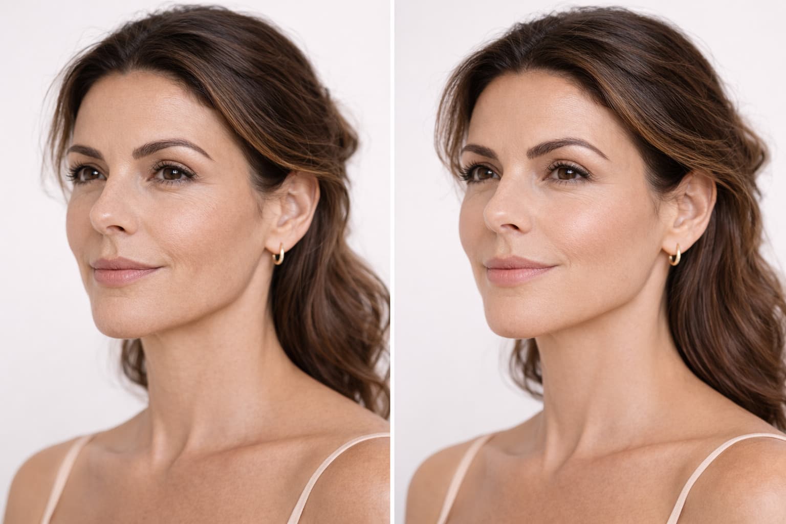 Tratamento com Radiesse bioestimulador de colágeno com hidroxiapatita